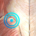 Myofascial Trigger Point Release Techniques for Pain Relief