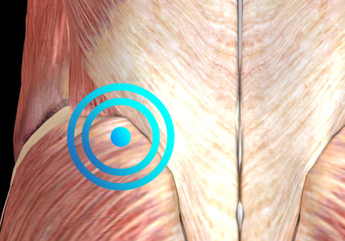 Myofascial Trigger Point Release Techniques for Pain Relief